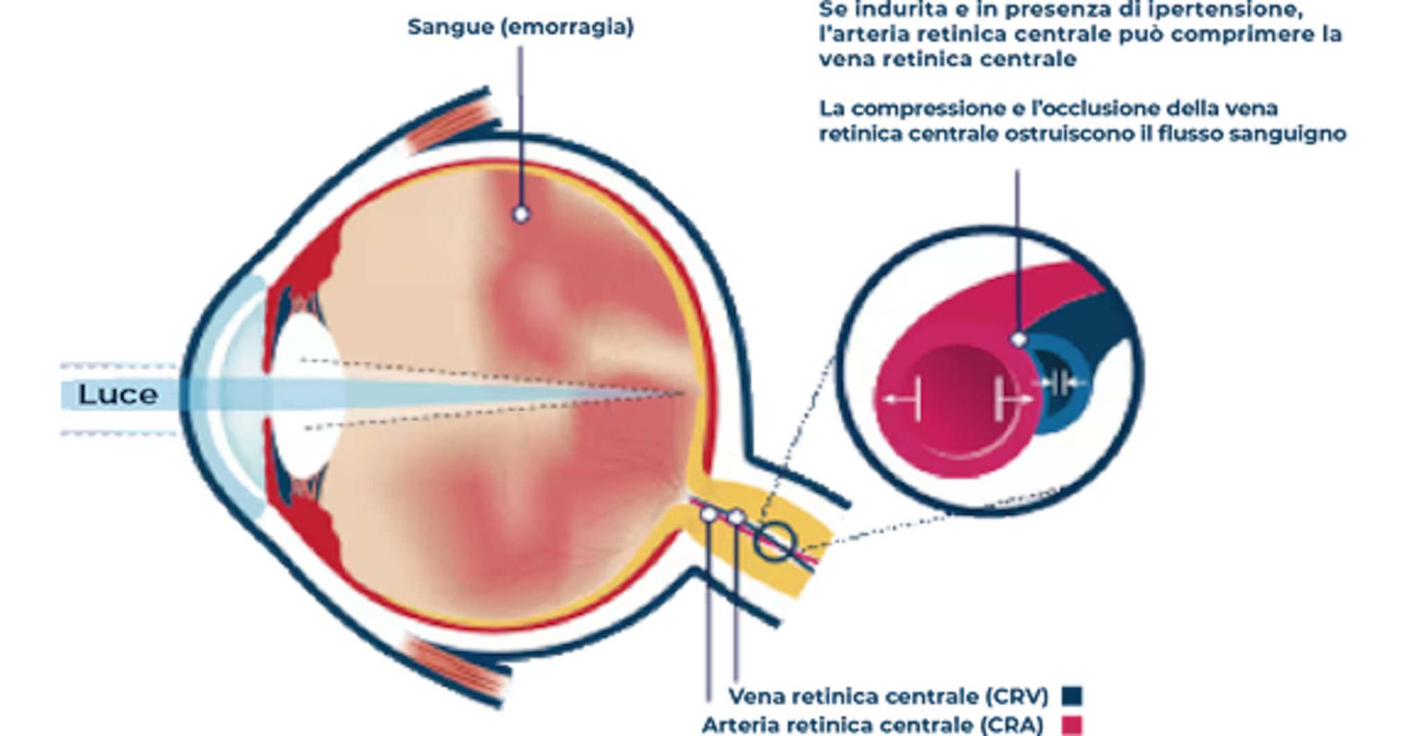 Sezione dell’occhio con evidenza di retina e macula, accompagnata da un ingrandimento degli strati retinici e della loro posizione nella parte posteriore dell’occhio.