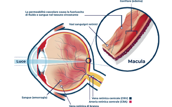 Illustrazione dell’occhio con dettaglio della macula affetta da edema, che evidenzia la fuoriuscita di liquidi dai vasi sanguigni retinici e il conseguente rigonfiamento del tessuto retinico