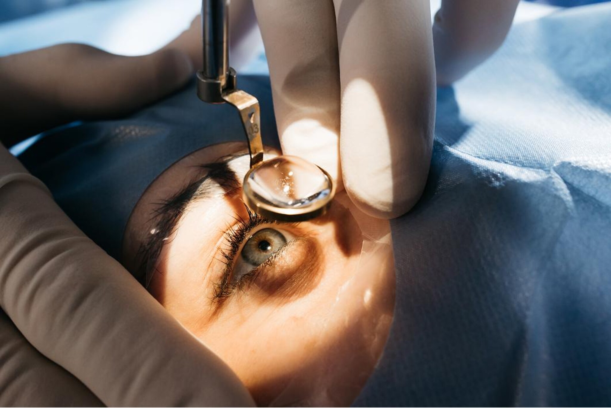 preparazione dell'occhio durante una procedura di iniezione intravitreale