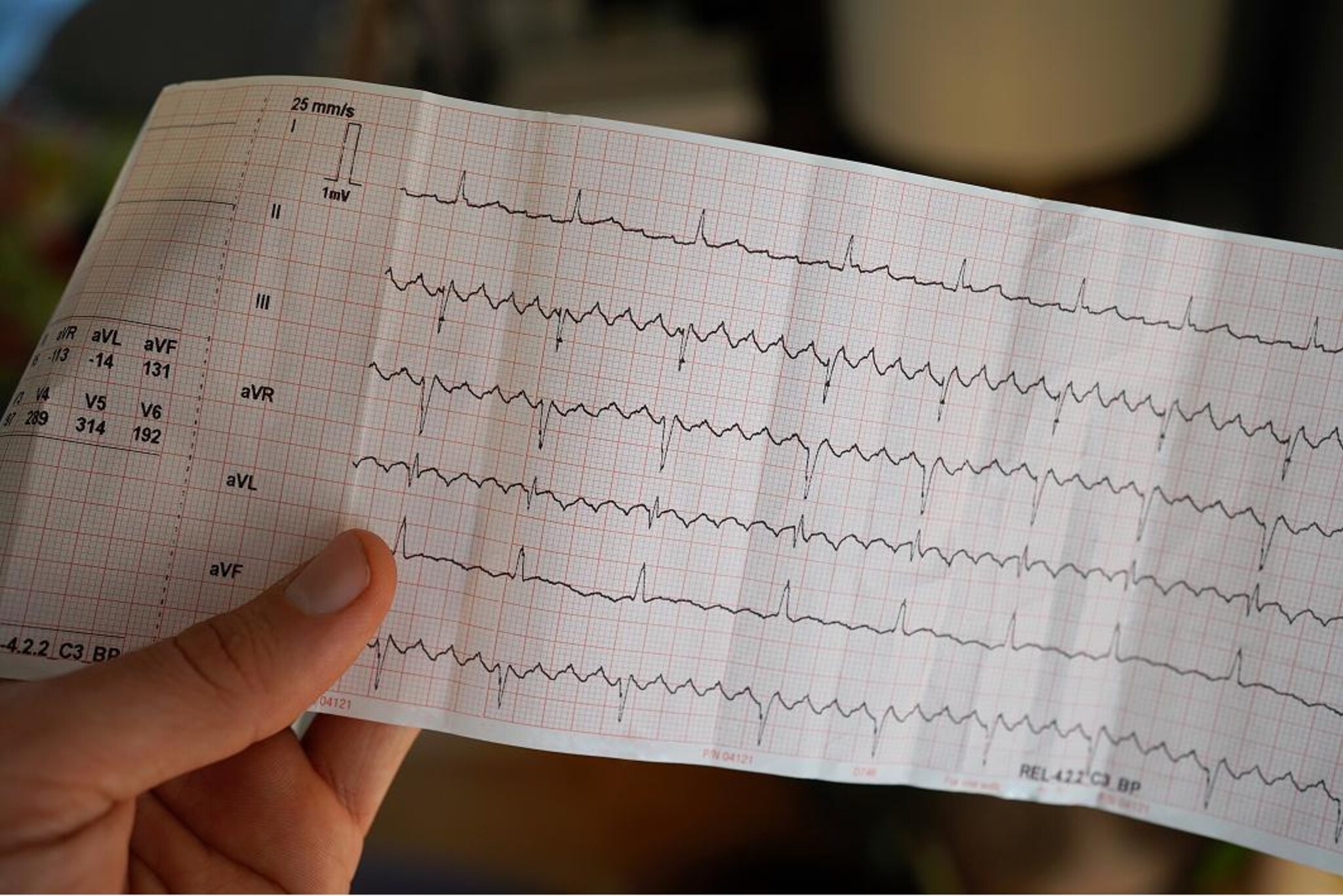 Elettrocardiogramma stampato su carta millimetrata, tenuto in mano, con diversi tracciati dell'attività elettrica cardiaca.
